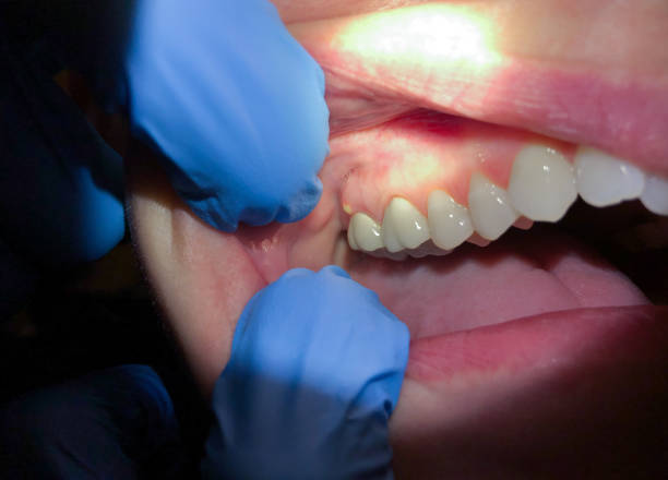 Best Emergency Dental Care for Broken or Chipped Teeth in Belmont Estates, VA
