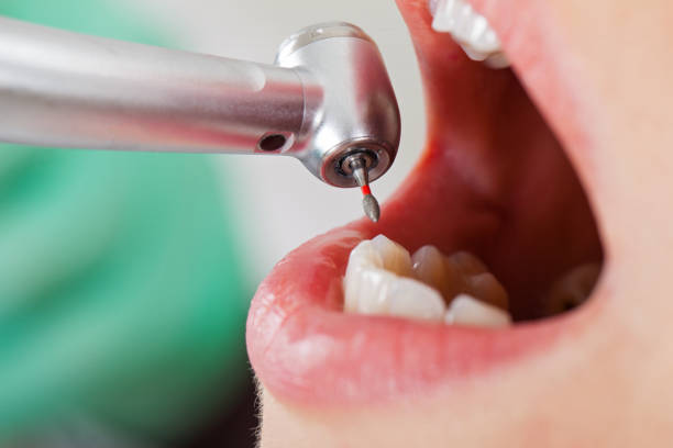 Best Emergency Treatment for Dental Infections or Abscesses in Belmont Estates, VA